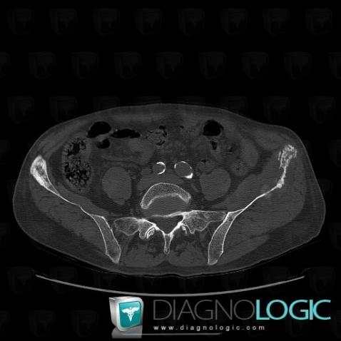 Metastasis, Ilium, CT