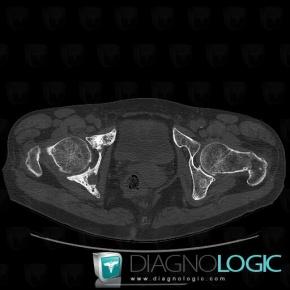 Metastasis, Ilium, CT
