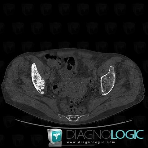 Metastasis, Ilium, CT