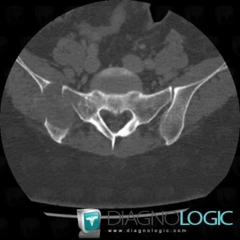 Metastasis, Ilium, CT