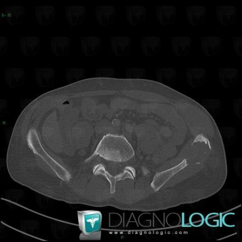 Metastasis, Ilium, CT