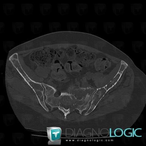 Metastasis, Ilium, CT