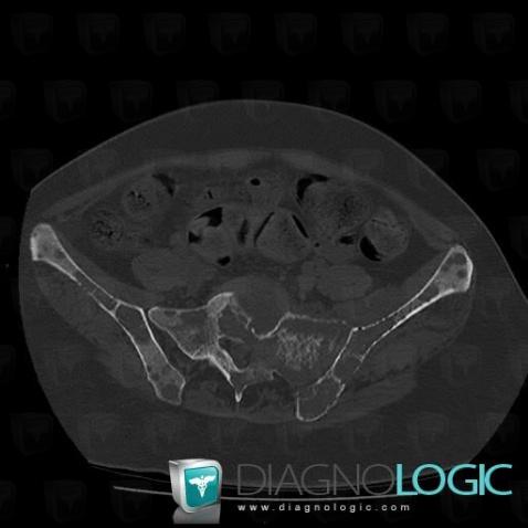 Metastasis, Ilium, CT