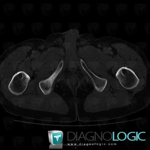 Metastasis, Ilium, CT