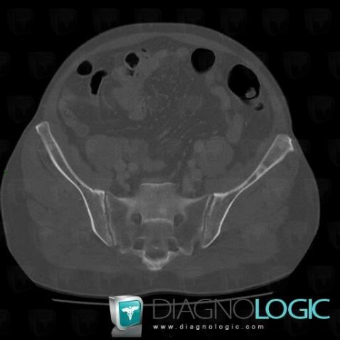 Metastasis, Ilium, CT
