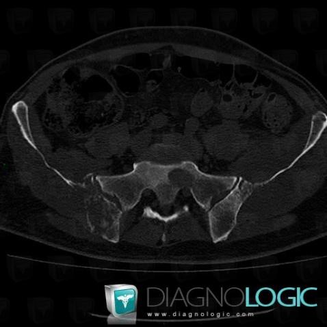 Metastasis, Ilium, CT