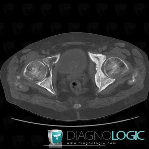 Metastasis, Ilium, CT