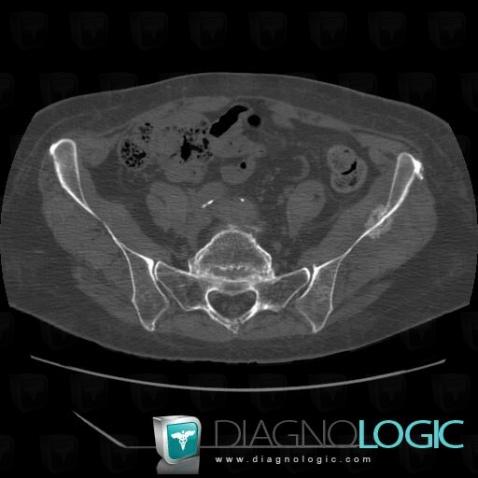 Metastasis, Ilium, CT