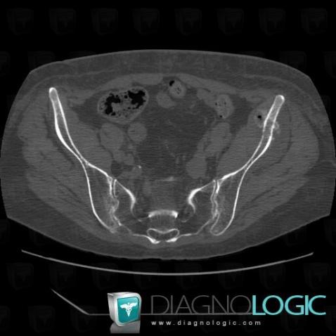 Metastasis, Ilium, CT