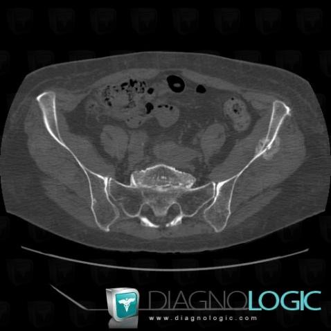 Metastasis, Ilium, CT