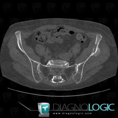 Metastasis, Ilium, CT