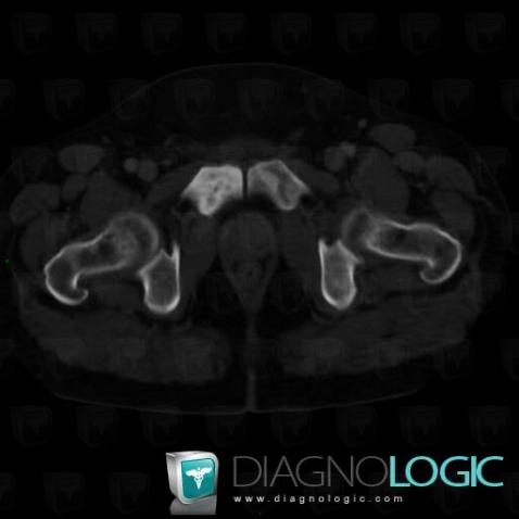 Metastasis, Ilium, CT