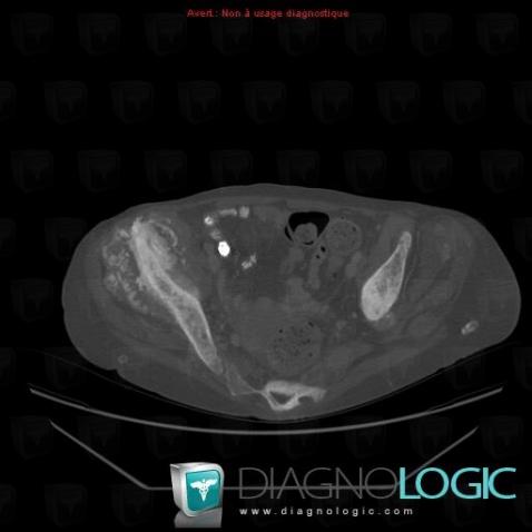 Metastasis, Ilium, CT