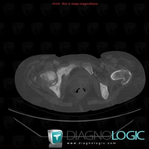 Metastasis, Ilium, CT