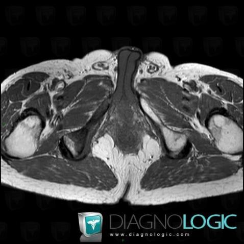 Metastasis, Ilium, MRI