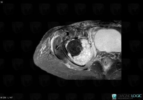 Metastasis, Ilium, MRI