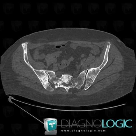 Metastasis, Ilium, Sacrum / Coccyx, CT