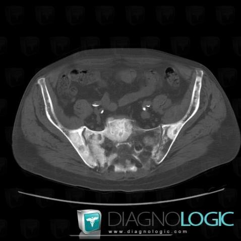 Metastasis, Ilium, Sacrum / Coccyx, CT