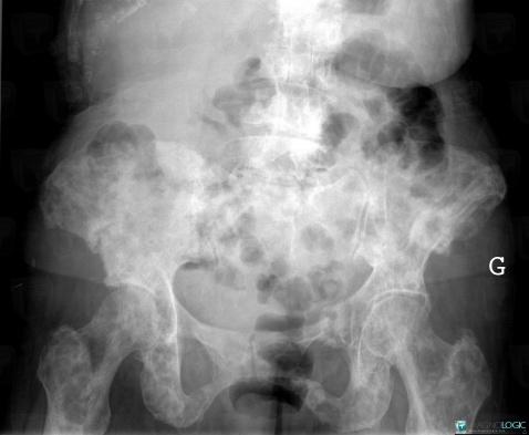 Metastasis, Ilium, Sacrum / Coccyx, X rays