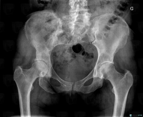 Metastasis, Ilium, Sacrum / Coccyx, X rays