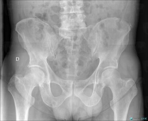 Metastasis, Ilium, X rays