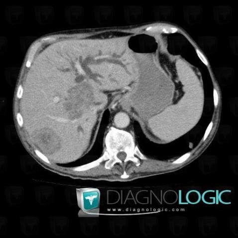 Metastasis, Intra and extra hepatic bile ducts, CT