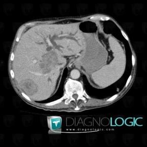 Metastasis, Intra and extra hepatic bile ducts, CT