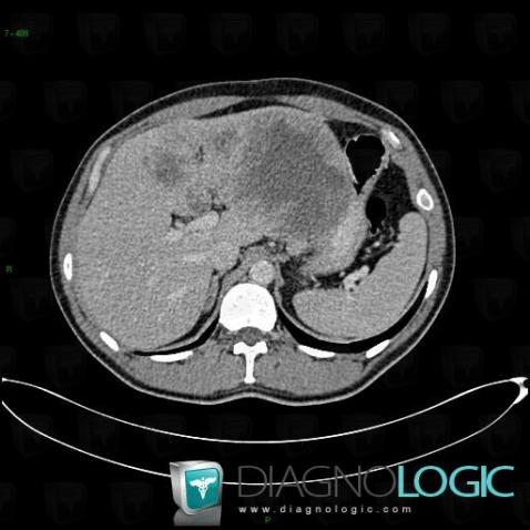 Metastasis, Liver, CT