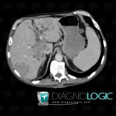 Metastasis, Liver, CT