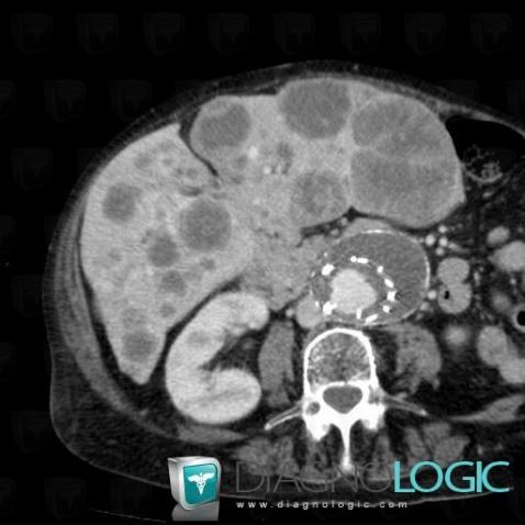 Metastasis, Liver, CT