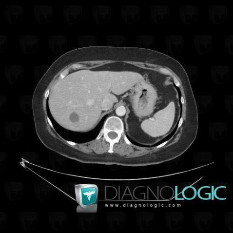 Metastasis, Liver, CT