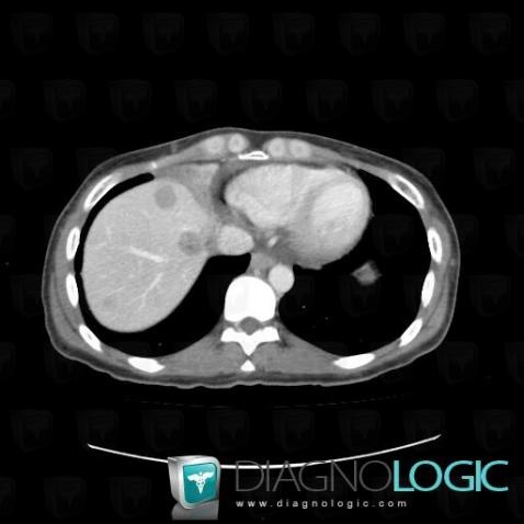 Metastasis, Liver, CT