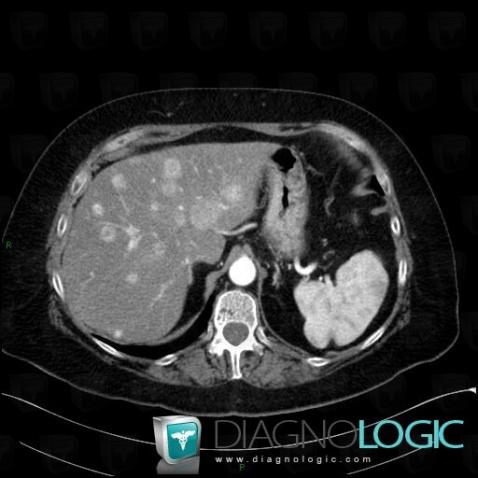 Metastasis, Liver, CT