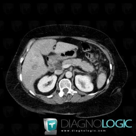 Metastasis, Liver, CT