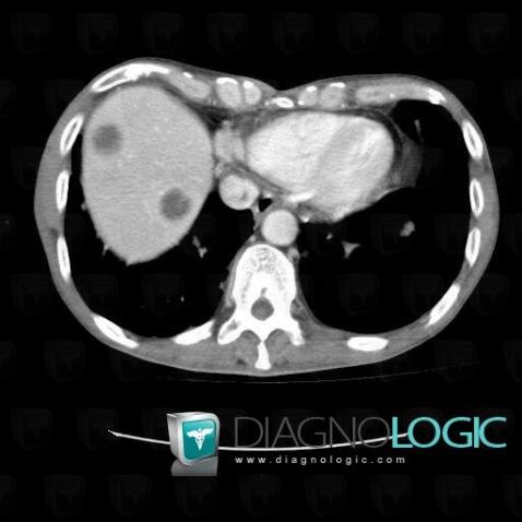 Metastasis, Liver, CT