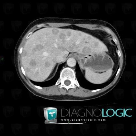 Metastasis, Liver, CT