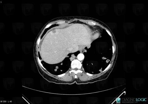 Metastasis, Liver, CT