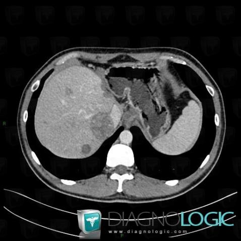 Metastasis, Liver, CT