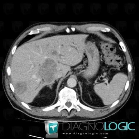 Metastasis, Liver, CT