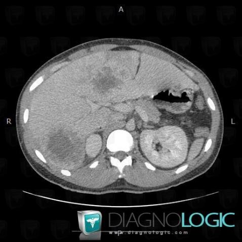 Metastasis, Liver, CT