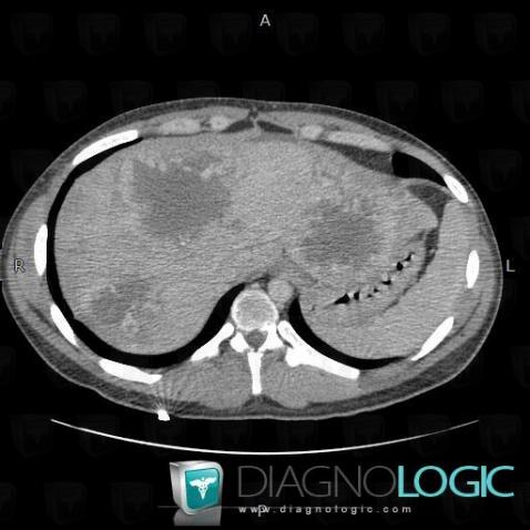 Metastasis, Liver, CT