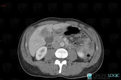 Metastasis, Liver, CT