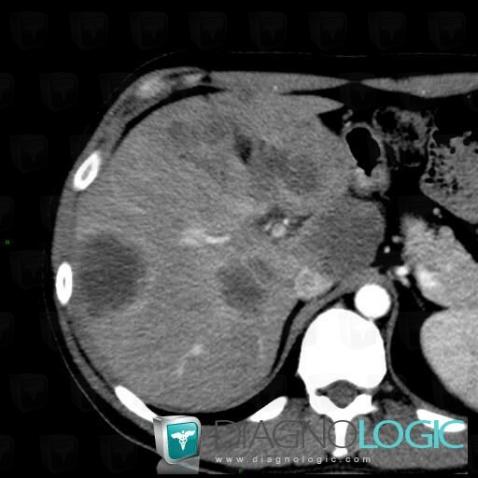 Metastasis, Liver, CT