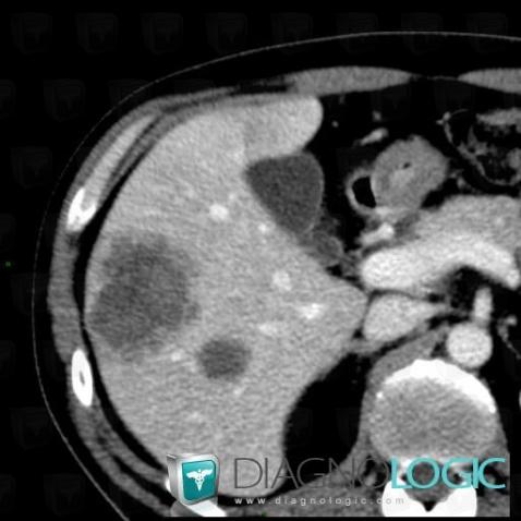 Metastasis, Liver, CT