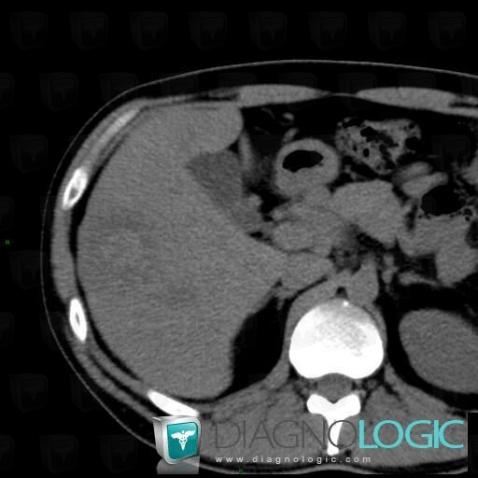 Metastasis, Liver, CT