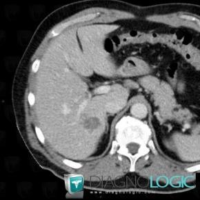 Metastasis, Liver, CT