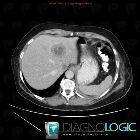 Metastasis, Liver, CT