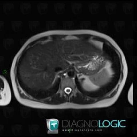 Metastasis, Liver, MRI