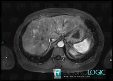 Metastasis, Liver, MRI