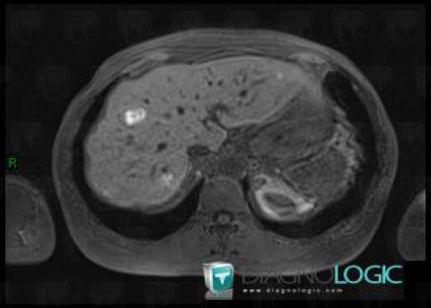 Metastasis, Liver, MRI